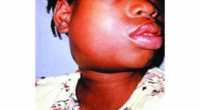 12 months Mumps outbreak in Bulawayo