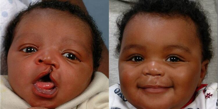Innscor says to redouble efforts to bring smiles to children with cleft lip