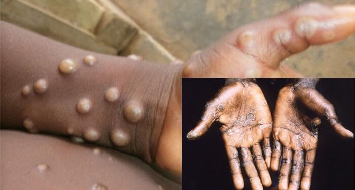 SA confirms five cases of Mpox with transimission associated with male-to-male s3xual contact