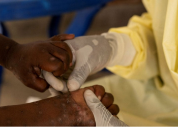 WHO says partners can start talks to buy mpox vaccines before its approval