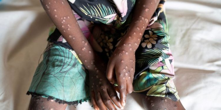 Mpox scare in Harare dispelled after negative test results