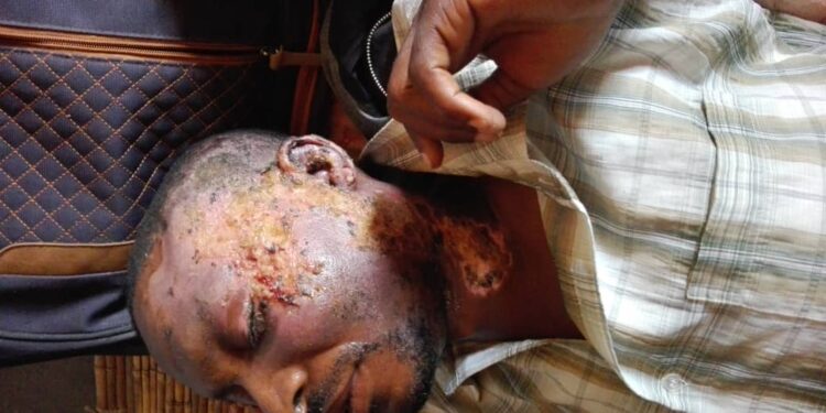 Burnt Victim’s Plea for Help After Desperate Escape from Hospital